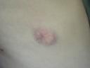 paintball_bruise2.jpg