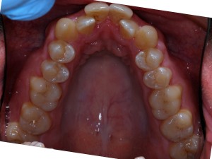 Teeth5 2014-05-07