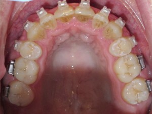 Teeth5 2015-10-07